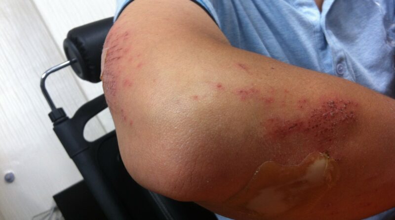 Photo d'une blessure au bras
