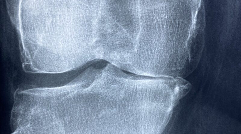 Photo d'une radiographie d'un genou présentant de l'arthrose