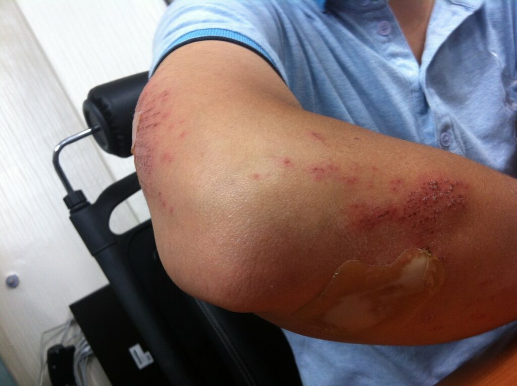 Photo d'une blessure au bras